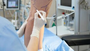 Chirurgie vasculaire : quand consulter et quel rôle face aux maladies circulatoires ?